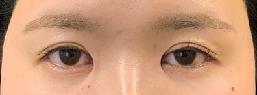 他院目頭切開術後修正の症例写真[アフター]