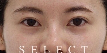 目の下ベビーコラーゲン注入 目元のくぼみ 目尻のしわの症例 Select Clinic セレクトクリニック Cs 美容医療の口コミ広場