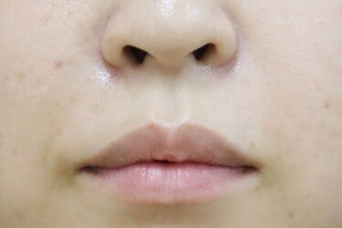 口角ボトックスの症例写真[ビフォー]