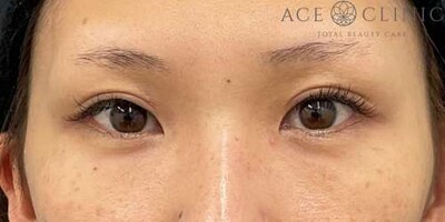 二重全切開法の症例写真[アフター]