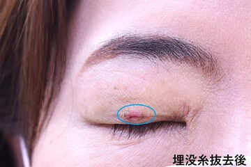 医療法人秀晄会 心斎橋コムロ美容外科クリニックの症例写真[アフター]