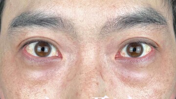 AI Beauty Clinicの目元・クマ・眉下・涙袋整形の症例写真[ビフォー]