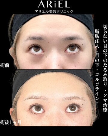 アリエル美容クリニック 横浜院の目元・クマ・眉下・涙袋整形の症例写真