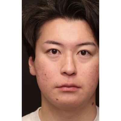 男性の裏ハムラ法で疲れ顔の目元を改善（術後3ヶ月）の症例写真[ビフォー]