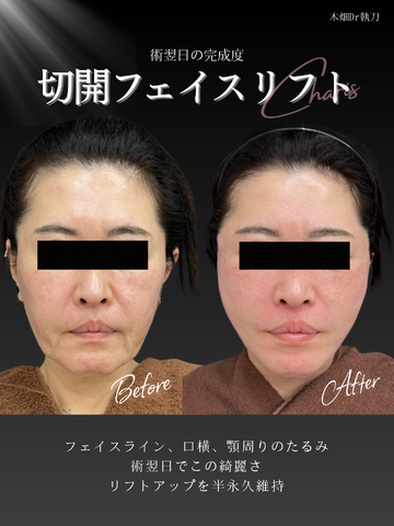 CHARIS BEAUTY CLINICのしわ・たるみ整形(注入、糸、フェイスリフト)の症例写真