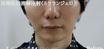 静岡美容外科橋本クリニックの鼻の整形の症例写真[ビフォー]