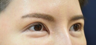他院目頭切開術後の症例写真[アフター]