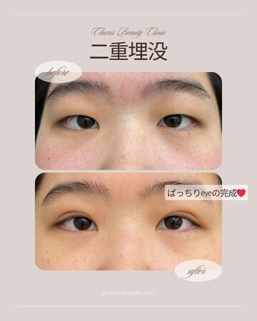 CHARIS BEAUTY CLINICの目・二重整形の症例写真