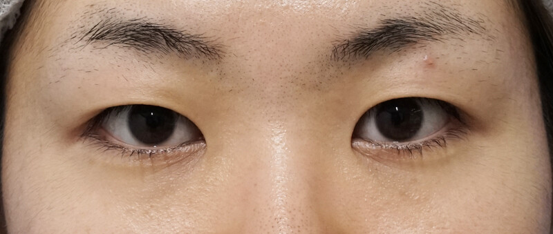 もとびアイプラチナム 【3ヶ月後 】 (二重埋没法の症例写真・画像) - もとび美容外科クリニック 新宿院 (Cs29157)《美容医療の口コミ広場》