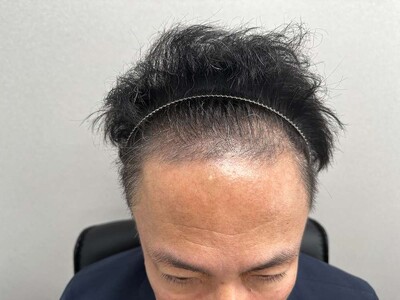 自毛植毛1000グラフト｜50代｜3回の症例写真[ビフォー]