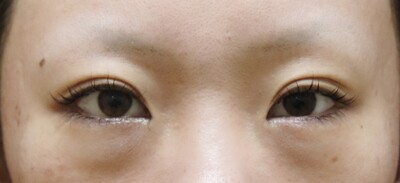 目頭切開の症例写真[ビフォー]