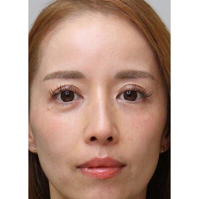 片側の裏ハムラと眉下切開で目元を整えるの症例写真[アフター]