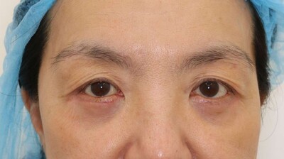 ハムラ法の症例写真[アフター]