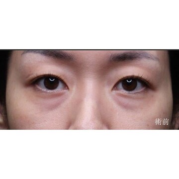 聖心美容クリニックの目元の症例写真[ビフォー]
