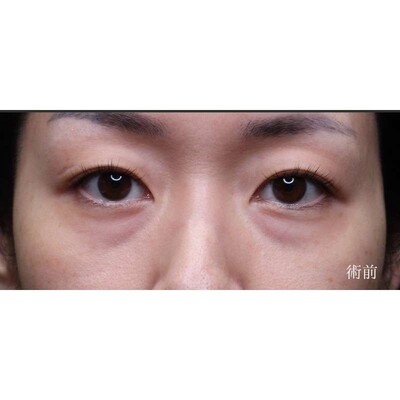裏ハムラ法で疲れ顔の原因の影を改善（術後1ヶ月）の症例写真[ビフォー]