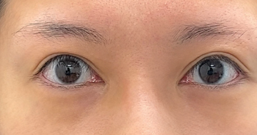 ユア美容クリニック 大阪院の目・二重整形の症例写真[ビフォー]
