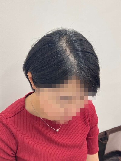 ヘアアートメイク｜40代｜2回の症例写真[ビフォー]