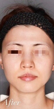 ピコレーザーを用いた美肌治療 シミ取り 肝斑 毛穴治療の症例 Select Clinic セレクトクリニック Cs 美容医療の口コミ広場