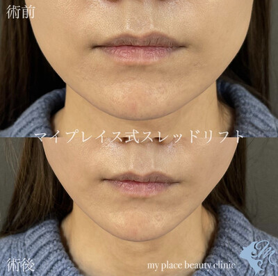 マイプレイス式スレッド6本の症例写真