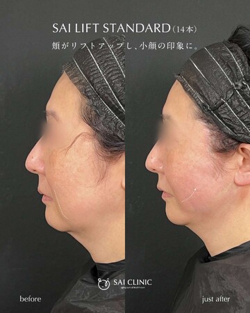 SAI CLINIC （サイクリニック）のリフトアップの症例写真