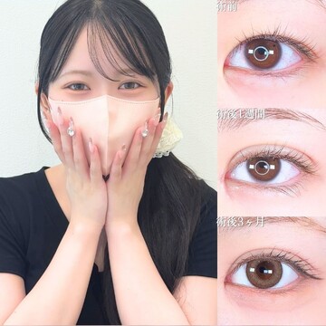 アリエル美容クリニック 大宮院の目・二重整形の症例写真