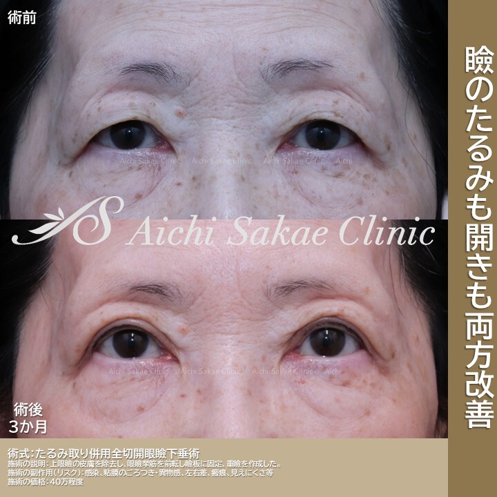 瞼のたるみも開きも両方改善(目・二重整形)の症例写真 (CS74130)|あいちビューティークリニック栄本院《美容医療の口コミ広場》