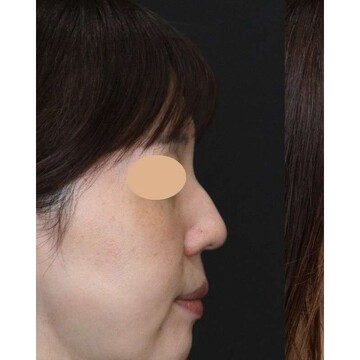 聖心美容クリニックの鼻の症例写真[ビフォー]
