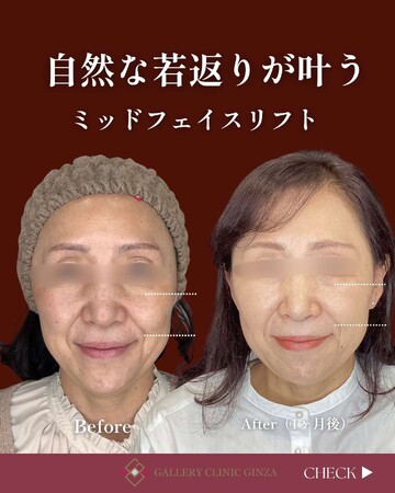 ギャラリークリニックの目元・クマ・眉下・涙袋整形の症例写真