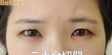 さかえ皮フ科クリニック（旧：ニドークリニック名古屋）の目・二重整形の症例写真[ビフォー]