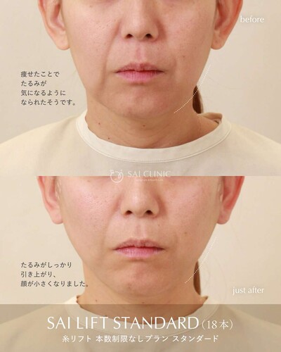 糸リフト（SAI LIFT PERFECT）18本の症例写真