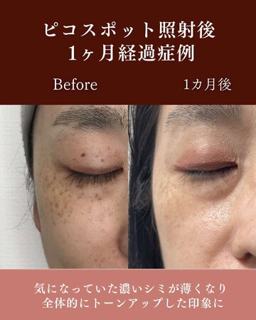 ギャラリークリニックのシミ・肝斑の症例写真