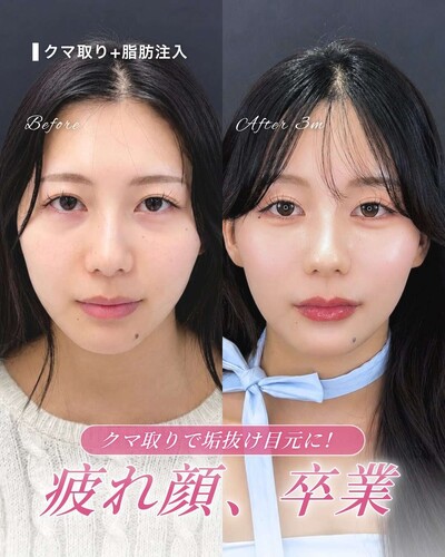 【目の下のふくらみ取り(脂肪注入セット)】
の症例写真