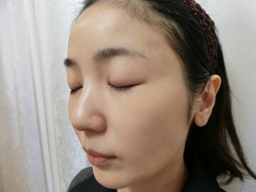 やさしい美容皮膚科・皮フ科 秋葉原院/シミレーザー東京のシミ・肝斑の症例写真[ビフォー]