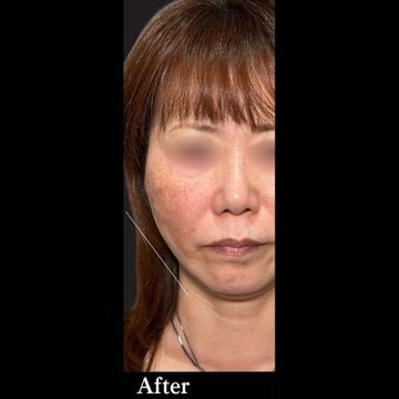 PRISM Beauty Clinicの症例写真[アフター]