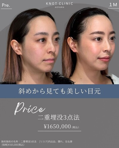 二重埋没の症例写真