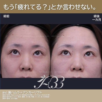 あいちビューティークリニック栄本院の目元・クマ・眉下・涙袋整形の症例写真