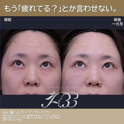 軽いクマでも治してみるとちゃんと若返るの症例写真