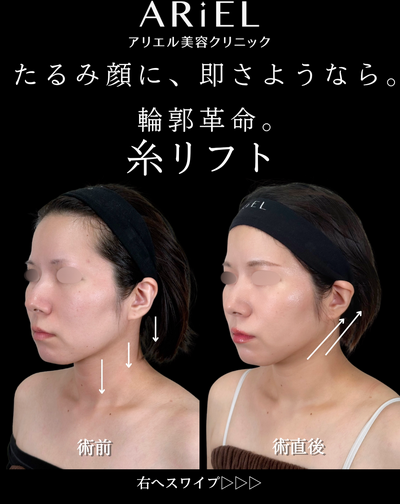 糸リフトの症例写真