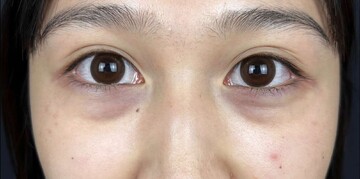AI Beauty Clinicの目元・クマ・眉下・涙袋整形の症例写真[ビフォー]