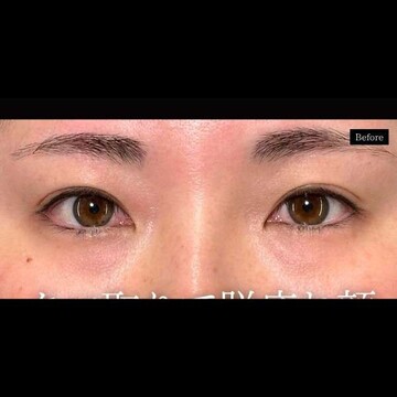 PRISM Beauty Clinicの目元の症例写真[ビフォー]