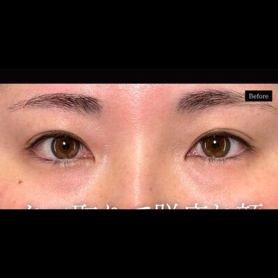 クマ取りとヒアルで目元を若返る⭐️の症例写真[ビフォー]