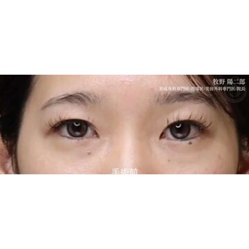 聖心美容クリニックの二重の症例写真[ビフォー]