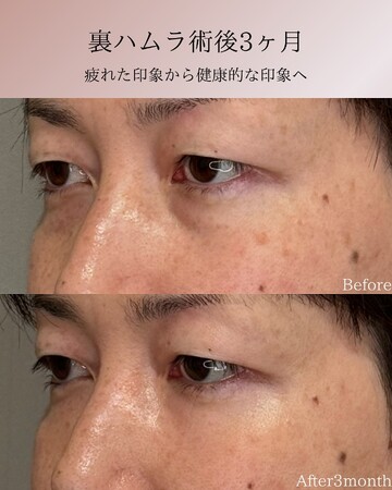 KNOT CLINIC AOYAMAの目元・クマ・眉下・涙袋整形の症例写真
