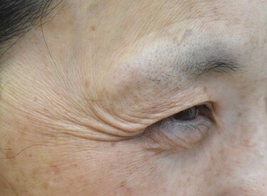 しわボトックス（目尻）の症例写真[ビフォー]