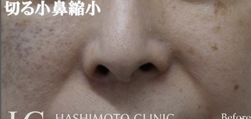 静岡美容外科橋本クリニックの鼻の整形の症例写真[ビフォー]