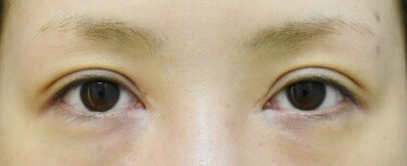 他院目頭切開術後修正の症例写真