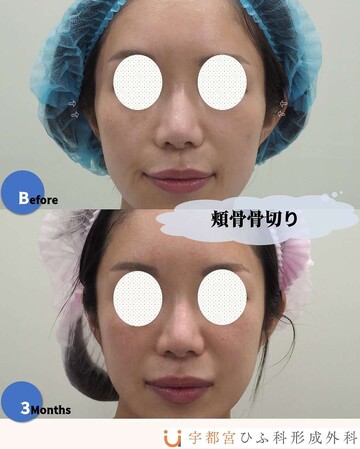 宇都宮ひふ科形成外科の輪郭・顎・エラ・額・小顔整形の症例写真