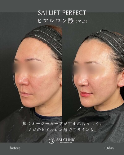 糸リフト：18本 ＋ヒアルロン酸：1cc（アゴ）の症例写真