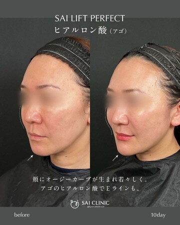 SAI CLINIC （サイクリニック）のリフトアップの症例写真