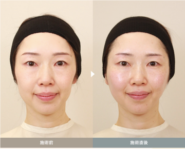 SAI CLINIC （サイクリニック）のリフトアップの症例写真